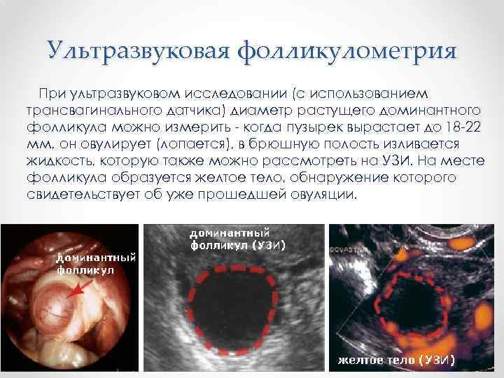Ультразвуковая фолликулометрия При ультразвуковом исследовании (с использованием трансвагинального датчика) диаметр растущего доминантного фолликула можно