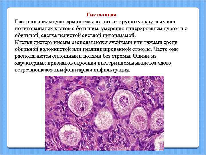 Гистология Гистологически дисгерминома состоит из крупных округлых или полигональных клеток с большим, умеренно гиперхромным