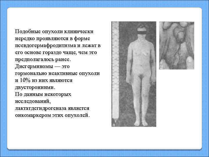 Подобные опухоли клинически нередко проявляются в форме псевдогермафродитизма и лежат в его основе гораздо