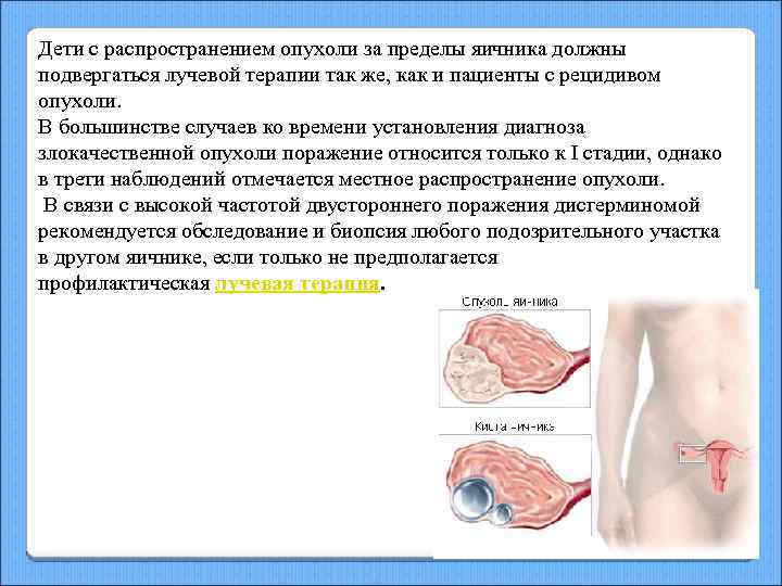 Дети с распространением опухоли за пределы яичника должны подвергаться лучевой терапии так же, как
