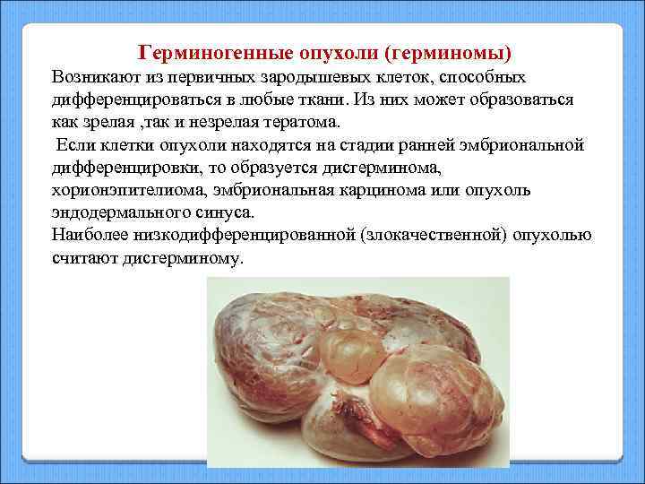 Герминогенные опухоли (герминомы) Возникают из первичных зародышевых клеток, способных дифференцироваться в любые ткани. Из