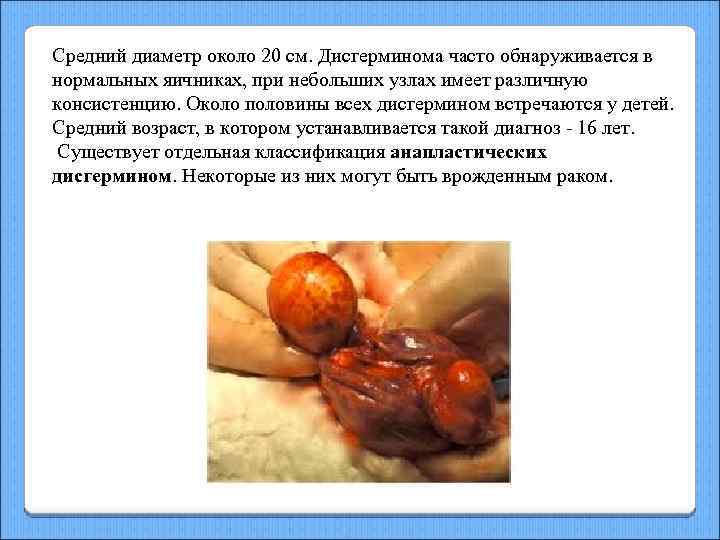 Средний диаметр около 20 см. Дисгерминома часто обнаруживается в нормальных яичниках, при небольших узлах