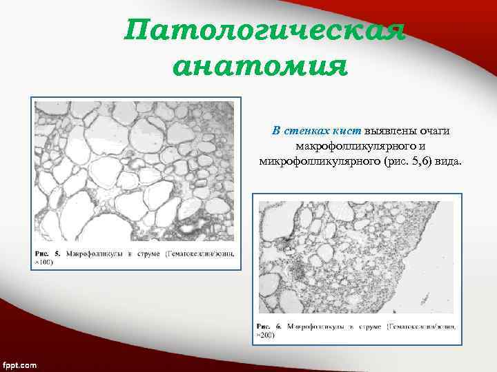 Патологическая анатомия В стенках кист выявлены очаги макрофолликулярного и микрофолликулярного (рис. 5, 6) вида.