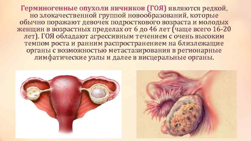 Герминогенные опухоли яичников (ГОЯ) являются редкой, но злокачественной группой новообразований, которые обычно поражают девочек