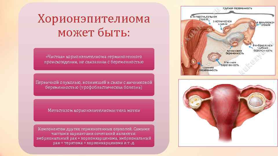 Хорионэпителиома может быть: «Чистая» хорионэпителиома герминогенного происхождения, не связанная с беременностью Первичной опухолью, возникшей