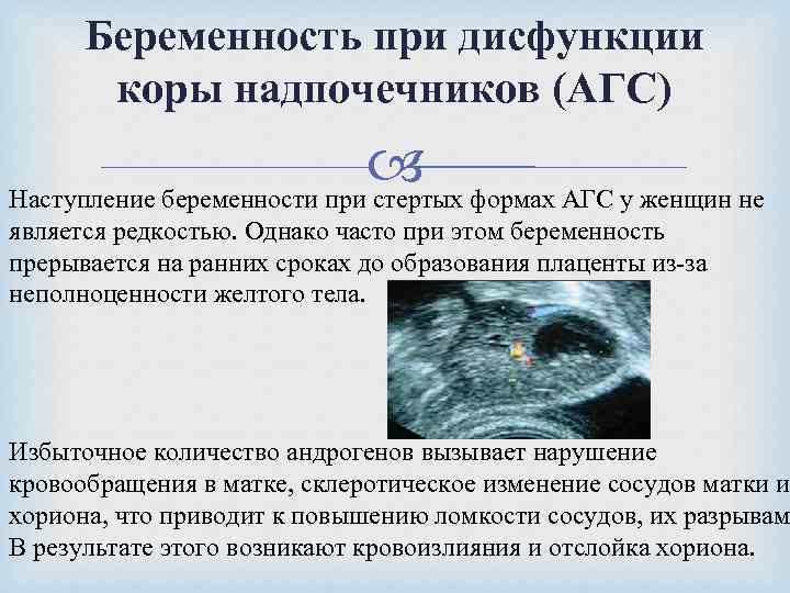 Беременность при дисфункции коры надпочечников (АГС) Наступление беременности при стертых формах АГС у женщин
