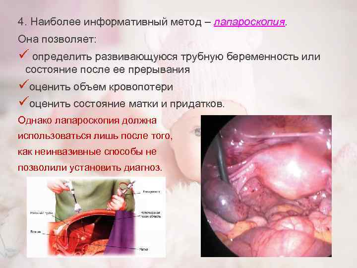 4. Наиболее информативный метод – лапароскопия. Она позволяет: ü определить развивающуюся трубную беременность или