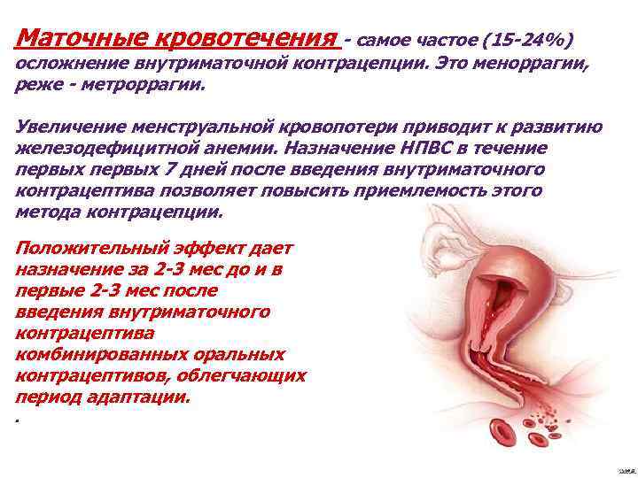 Маточные кровотечения - самое частое (15 -24%) осложнение внутриматочной контрацепции. Это меноррагии, реже -