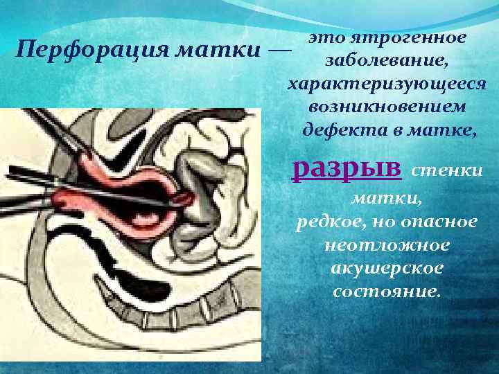 это ятрогенное Перфорация матки — заболевание, характеризующееся возникновением дефекта в матке, разрыв стенки матки,