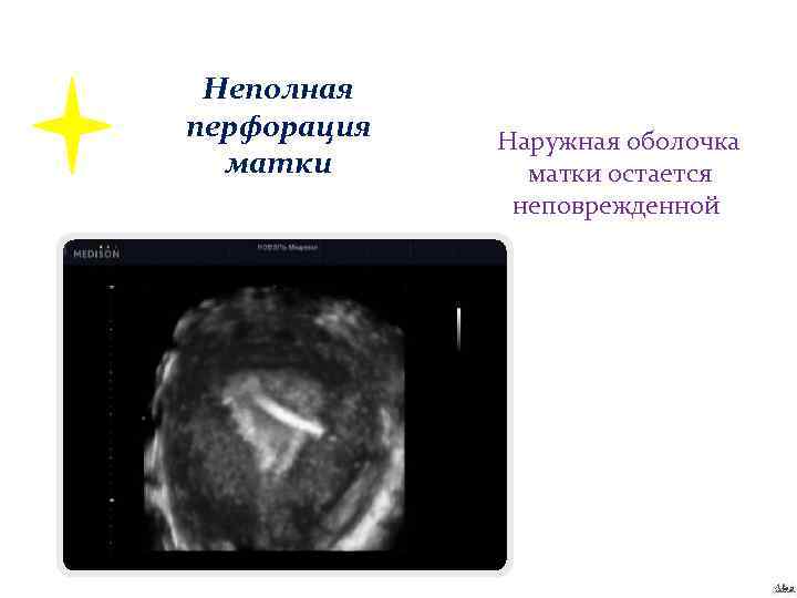Неполная перфорация матки Наружная оболочка матки остается неповрежденной 