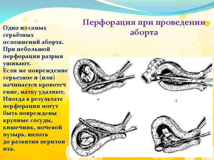 Одно из самых серьёзных осложнений аборта. При небольшой перфорации разрыв ушивают. Если же повреждение