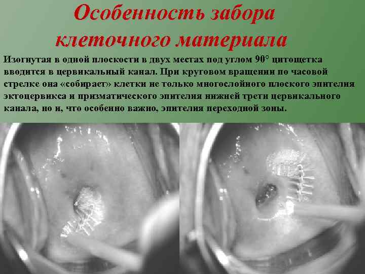 Особенность забора клеточного материала Изогнутая в одной плоскости в двух местах под углом 90°