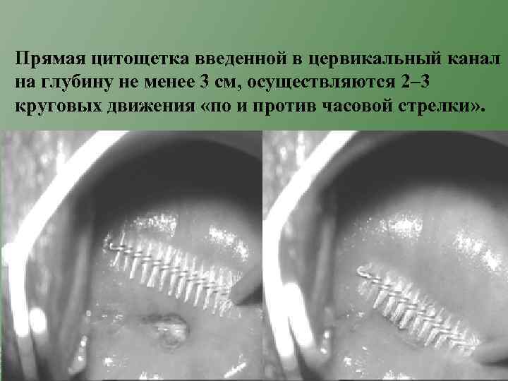 Прямая цитощетка введенной в цервикальный канал на глубину не менее 3 см, осуществляются 2–