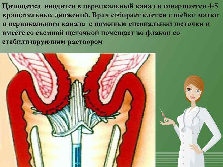 Цитощетка вводится в цервикальный канал и совершается 4 -5 вращательных движений. Врач собирает клетки