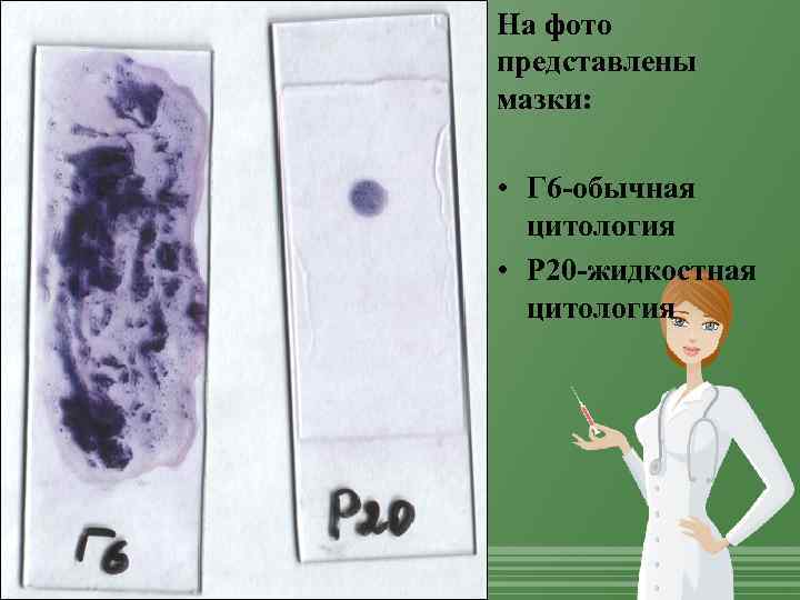 На фото представлены мазки: • Г 6 -обычная цитология • Р 20 -жидкостная цитология