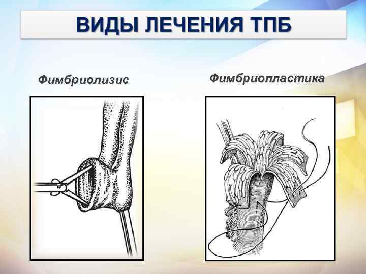 Фимбриолизис Фимбриопластика 