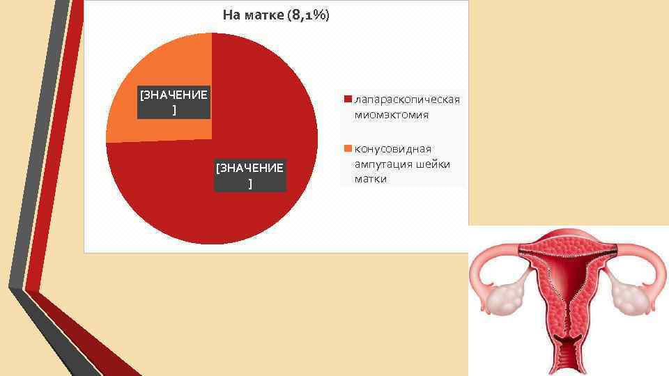 На матке (8, 1%) [ЗНАЧЕНИЕ ] лапараскопическая миомэктомия [ЗНАЧЕНИЕ ] конусовидная ампутация шейки матки