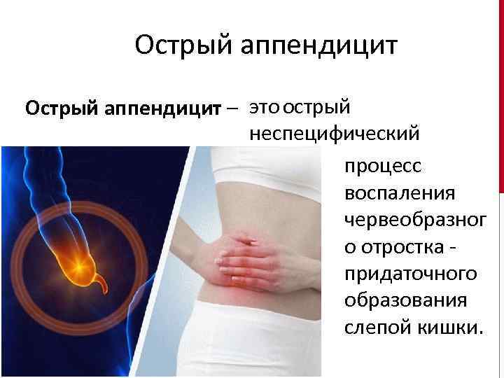 Острый аппендицит Острый аппендицит – это острый неспецифический процесс воспаления червеобразног о отростка -