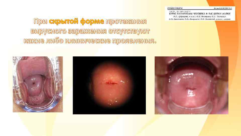 При скрытой форме протекания вирусного заражения отсутствуют какие либо клинические проявления. 