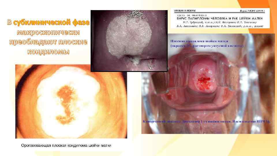 В субклинической фазе макроскопически преобладают плоские кондиломы 