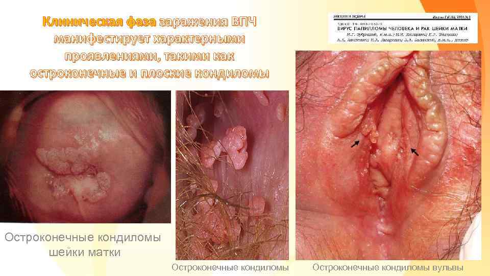 Клиническая фаза заражения ВПЧ манифестирует характерными проявлениями, такими как остроконечные и плоские кондиломы Остроконечные