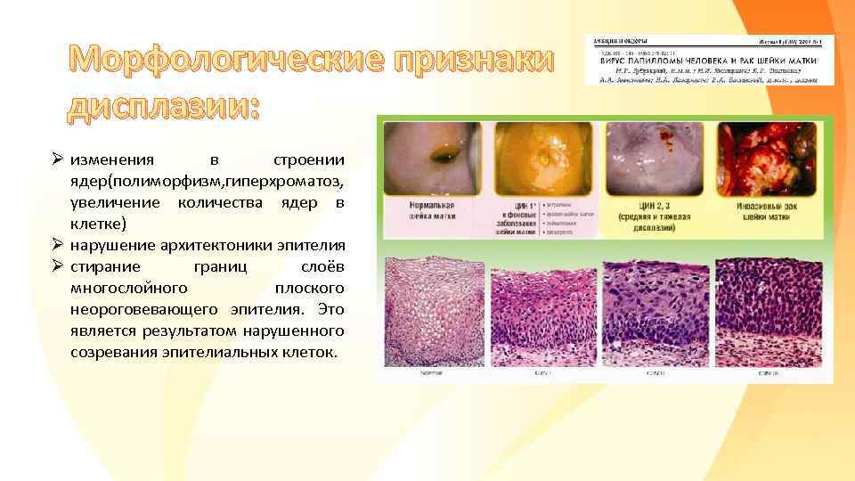 Морфологические признаки дисплазии: Ø изменения в строении ядер(полиморфизм, гиперхроматоз, увеличение количества ядер в клетке)