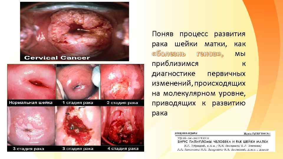 Поняв процесс развития рака шейки матки, как «болезнь генов» , мы приблизимся к диагностике