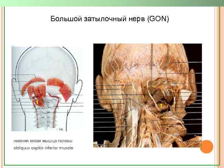 Большой затылочный нерв (GON) нижняя косая мышца головы obliquus capitis inferior muscle 