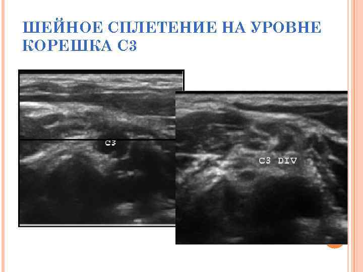 ШЕЙНОЕ СПЛЕТЕНИЕ НА УРОВНЕ КОРЕШКА C 3 