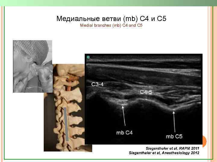 Медиальные ветви (mb) C 4 и C 5 Medial branches (mb) C 4 and