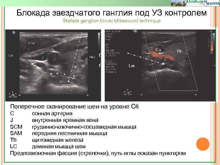 Блокада звездчатого ганглия под УЗ контролем Stellate ganglion block: Ultrasound technique Поперечное сканирование шеи