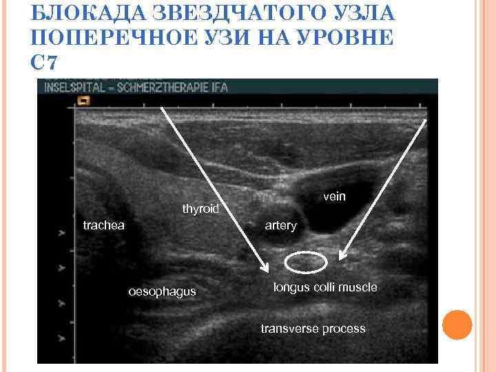 БЛОКАДА ЗВЕЗДЧАТОГО УЗЛА ПОПЕРЕЧНОЕ УЗИ НА УРОВНЕ C 7 vein thyroid trachea artery oesophagus