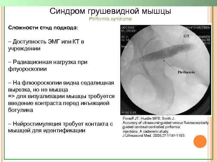 Синдром грушевидной мышцы Piriformis syndrome Сложности стнд подхода: - Доступность ЭМГ или КТ в