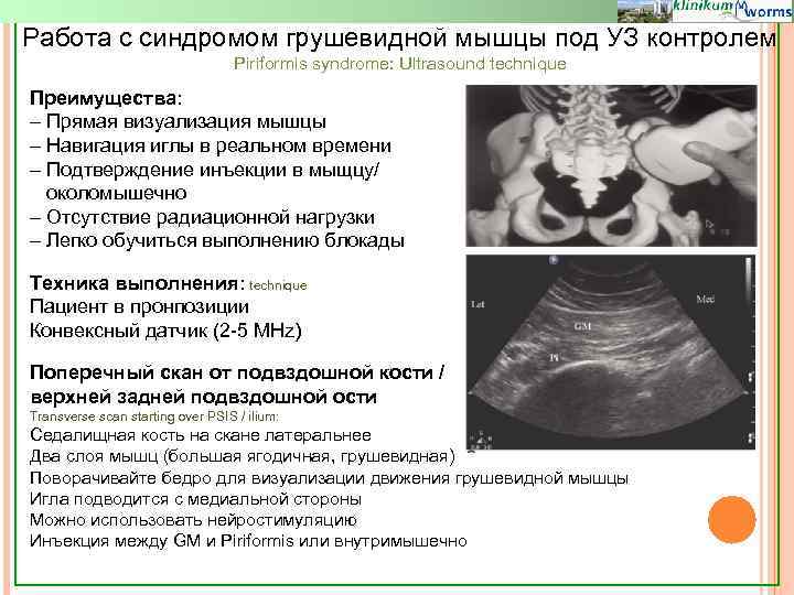 Работа с синдромом грушевидной мышцы под УЗ контролем Piriformis syndrome: Ultrasound technique Преимущества: -