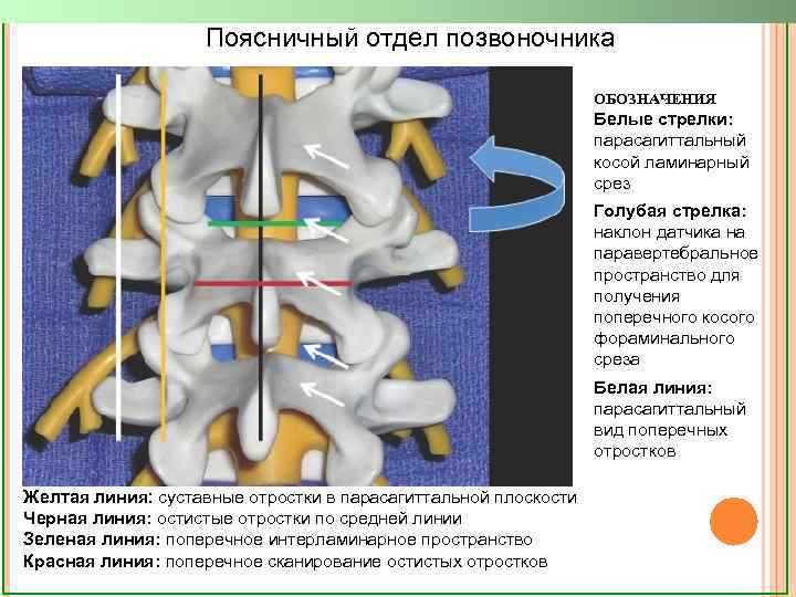 Поясничный отдел позвоночника ОБОЗНАЧЕНИЯ Белые стрелки: парасагиттальный косой ламинарный срез Голубая стрелка: наклон датчика