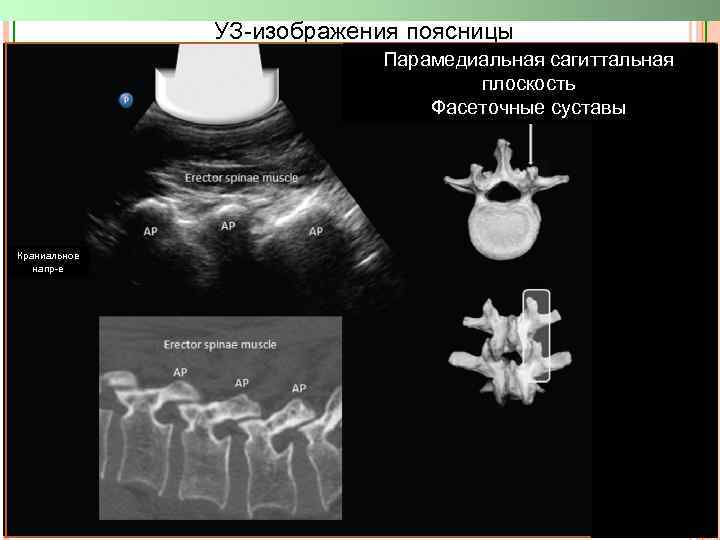 УЗ-изображения поясницы Парамедиальная сагиттальная плоскость Фасеточные суставы Краниальное напр-е 