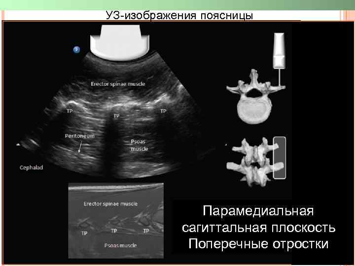 УЗ-изображения поясницы Парамедиальная сагиттальная плоскость Поперечные отростки 