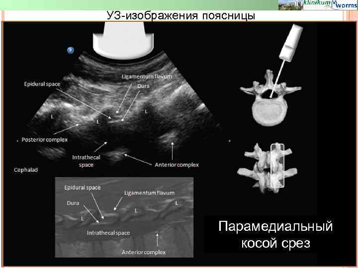 УЗ-изображения поясницы Парамедиальный косой срез 