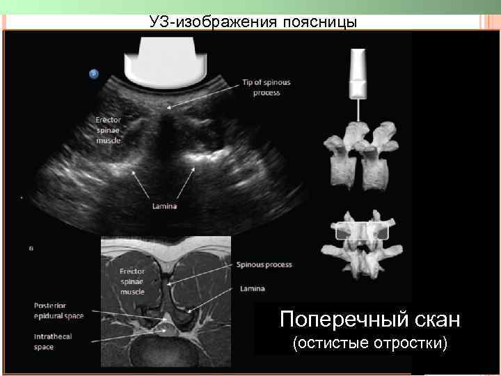 УЗ-изображения поясницы Поперечный скан (остистые отростки) 