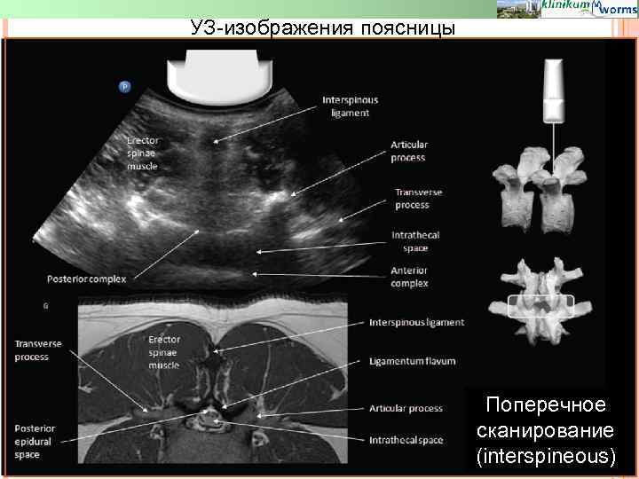 УЗ-изображения поясницы Поперечное сканирование (interspineous) 