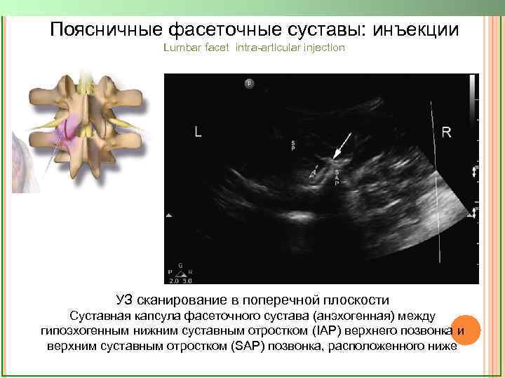 Поясничные фасеточные суставы: инъекции Lumbar facet intra-articular injection УЗ сканирование в поперечной плоскости Суставная