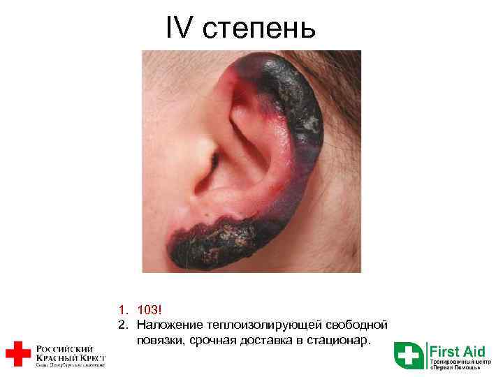 IV степень 1. 103! 2. Наложение теплоизолирующей свободной повязки, срочная доставка в стационар. 