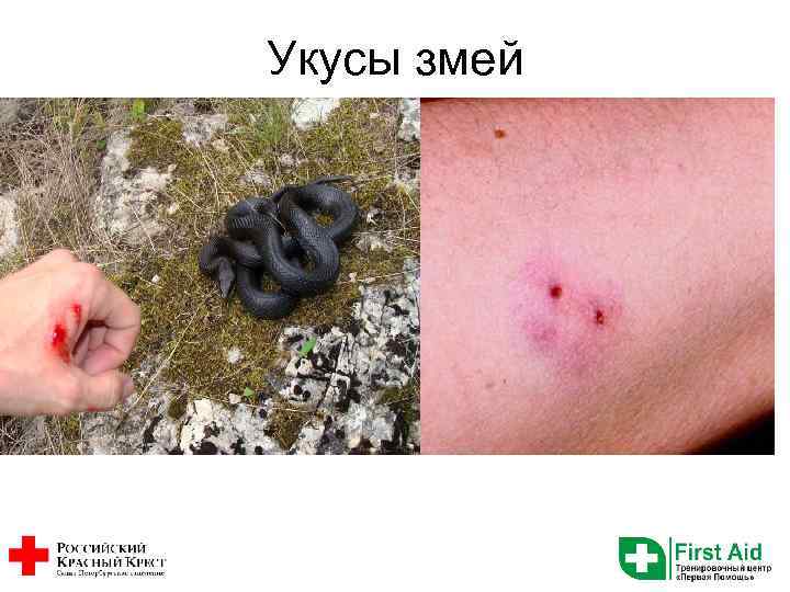 Укусы змей 
