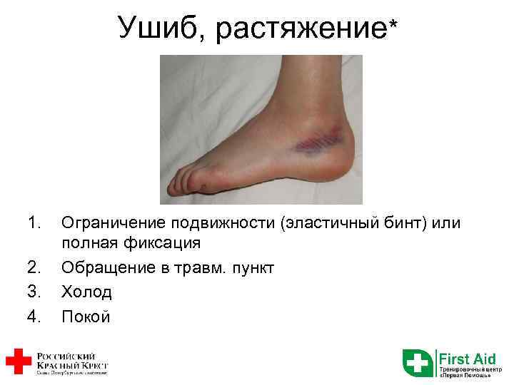 Ушиб, растяжение* 1. 2. 3. 4. Ограничение подвижности (эластичный бинт) или полная фиксация Обращение