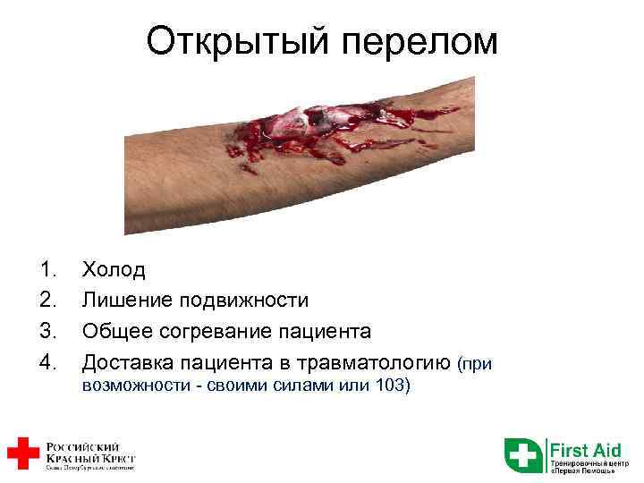 Открытый перелом 1. 2. 3. 4. Холод Лишение подвижности Общее согревание пациента Доставка пациента