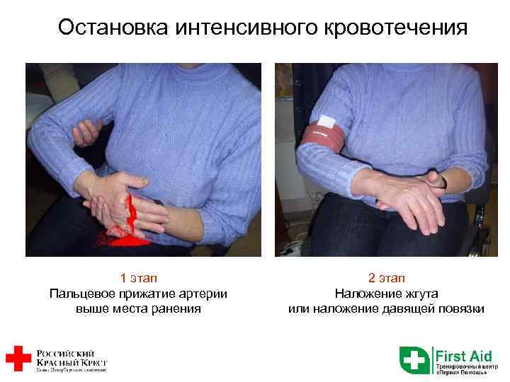 Остановка интенсивного кровотечения 1 этап Пальцевое прижатие артерии выше места ранения 2 этап Наложение