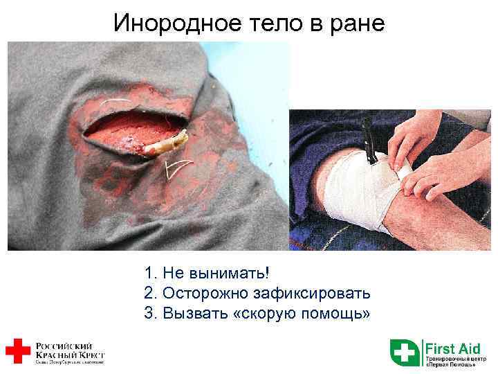 Инородное тело в ране 1. Не вынимать! 2. Осторожно зафиксировать 3. Вызвать «скорую помощь»
