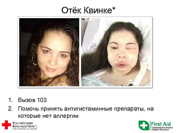 Отёк Квинке* 1. Вызов 103 2. Помочь принять антигистаминные препараты, на которые нет аллергии