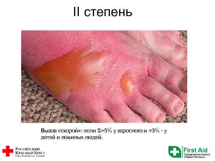 II степень Вызов «скорой» : если S>5% у взрослого и >3% - у детей