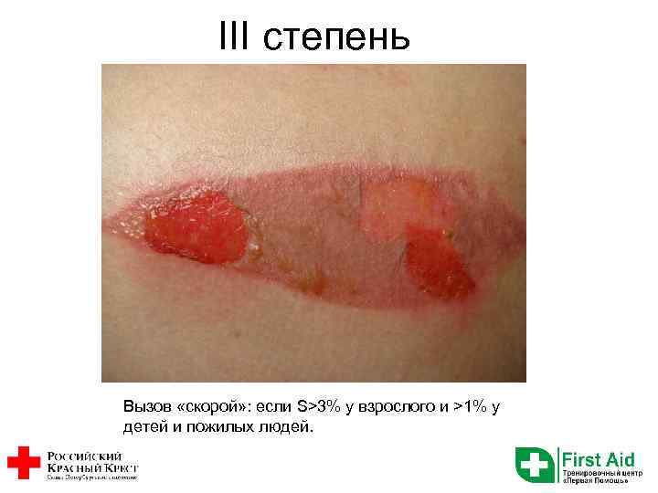 III степень Вызов «скорой» : если S>3% у взрослого и >1% у детей и